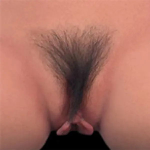 Implanted pubic hair
